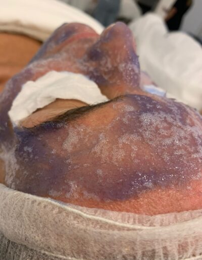 tratamientofacial3